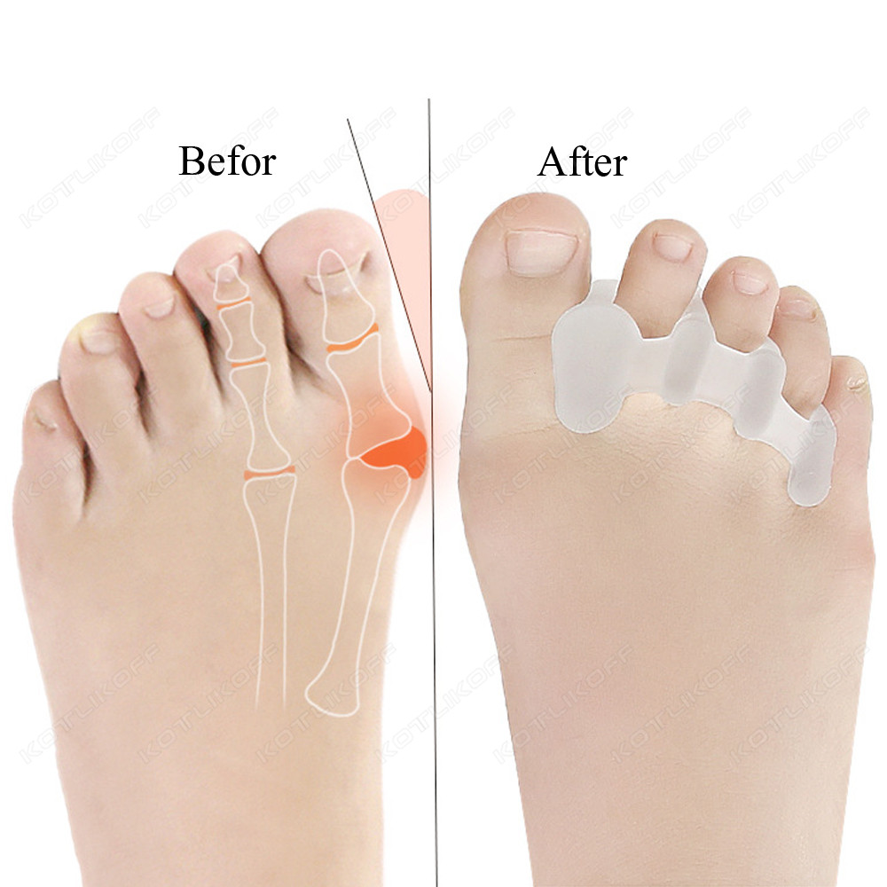 Teen Beschermende Tenen Separa - Toe Separator Silicon recensie en prijs